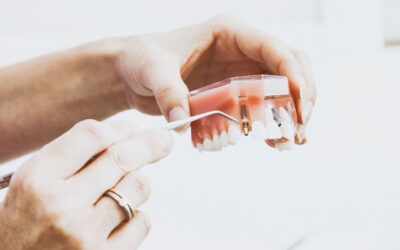 Implanturile dentare Nobel